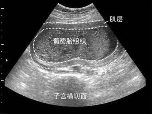 什么是葡萄胎？准妈妈怎样尽早发现？