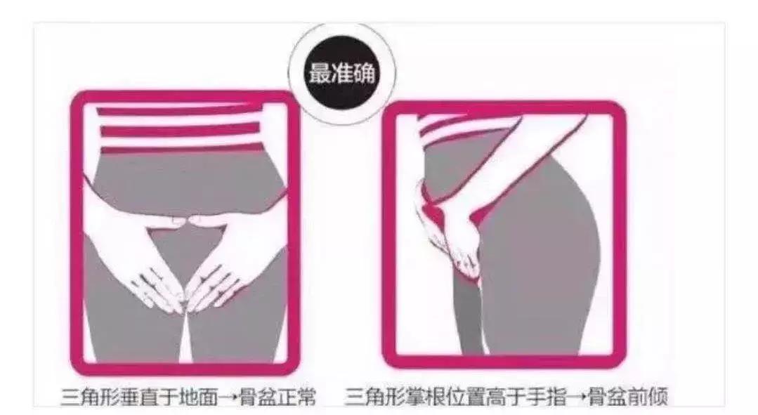 骨盆前倾怎么自我评测,骨盆前倾的自我测试和纠正的方法