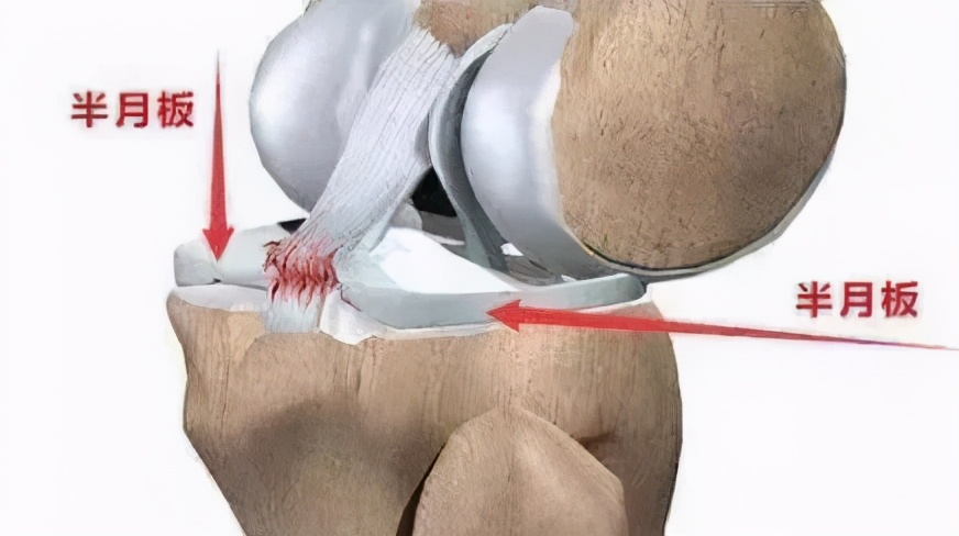 治疗半月板损伤最好的运动办法,运动导致半月板损伤很后悔