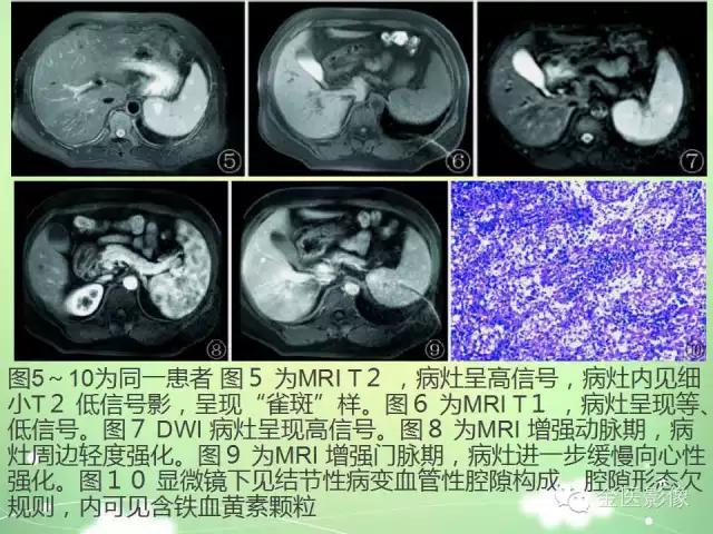 脾血管瘤中医辨证,脾血管瘤超声表现