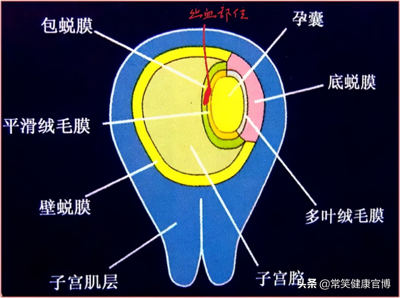 怀孕期间绒毛血肿怎么回事,怀孕绒毛膜下积血怎么消除