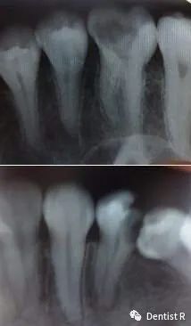 看牙为什么要拍照片,看牙拍片辐射大吗