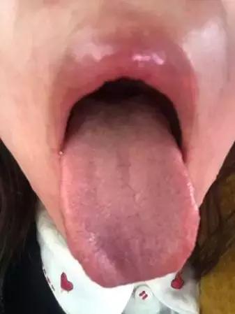 「许师解疑」难治性*疮痤**案析酸寒法