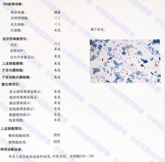 tct重度炎症用什么药治疗,TCT报告显示有炎症