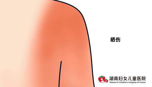 儿童身上皮疹反反复复怎么办,全身皮疹怎样止痒