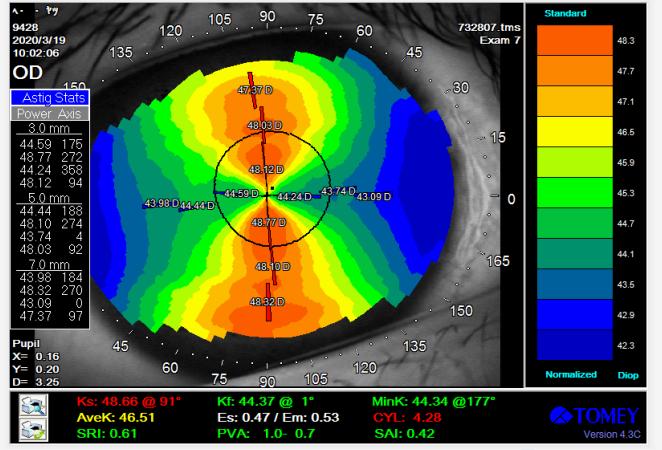 角膜散光大者一定不能配戴角膜塑形镜么？