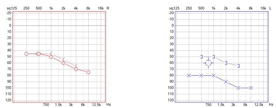 如何预防老年性神经性耳聋,如何预防中老年人耳聋
