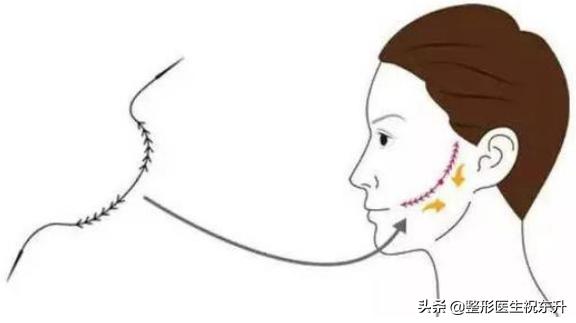 做完线雕半个月脸还是肿痛，是正常现象吗?知道的谈一谈