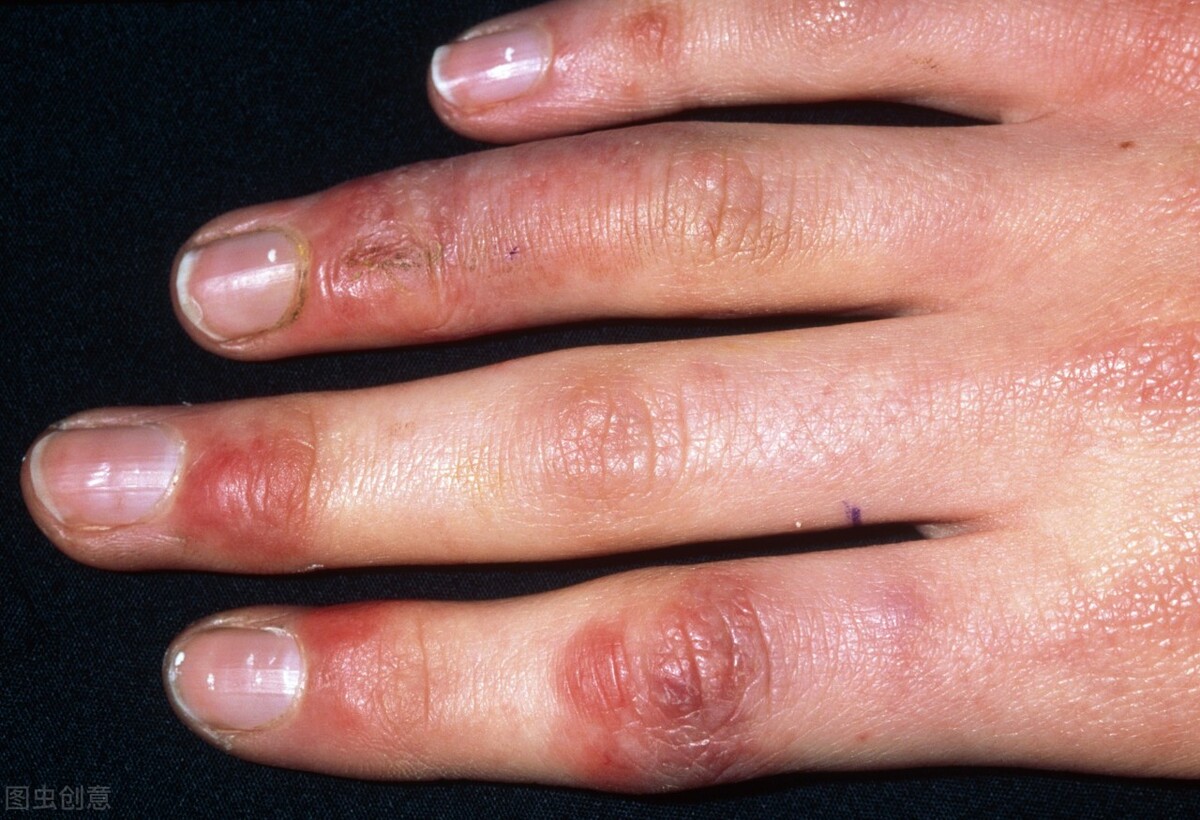 得了冻疮可以拿热水泡吗,手冻僵了用热水洗会冻疮吗