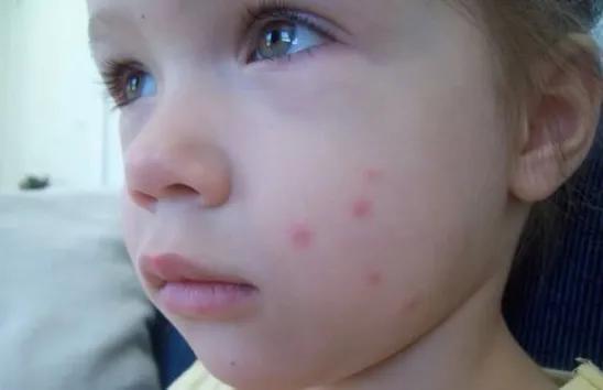 怎么防蚊子叮宝宝小技巧,夏天宝宝总被蚊子叮有什么好办法