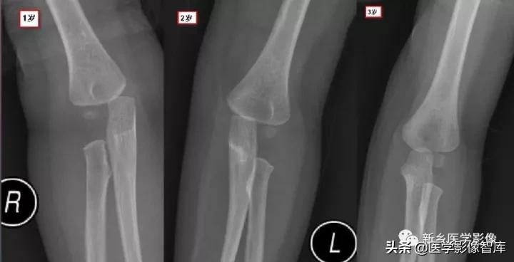肘关节x线测量,肘关节骨骺示意图