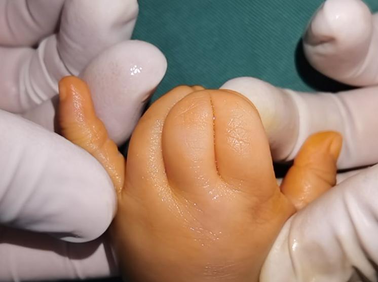 并指畸形免植皮案例,并指畸形