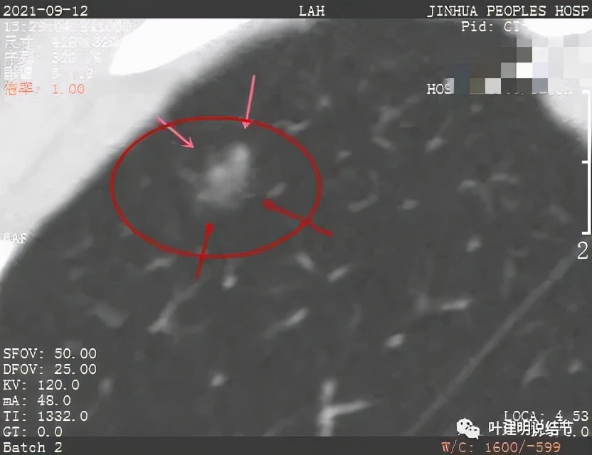 从活检怎么看是非小细胞癌,从病例谈辨证论治