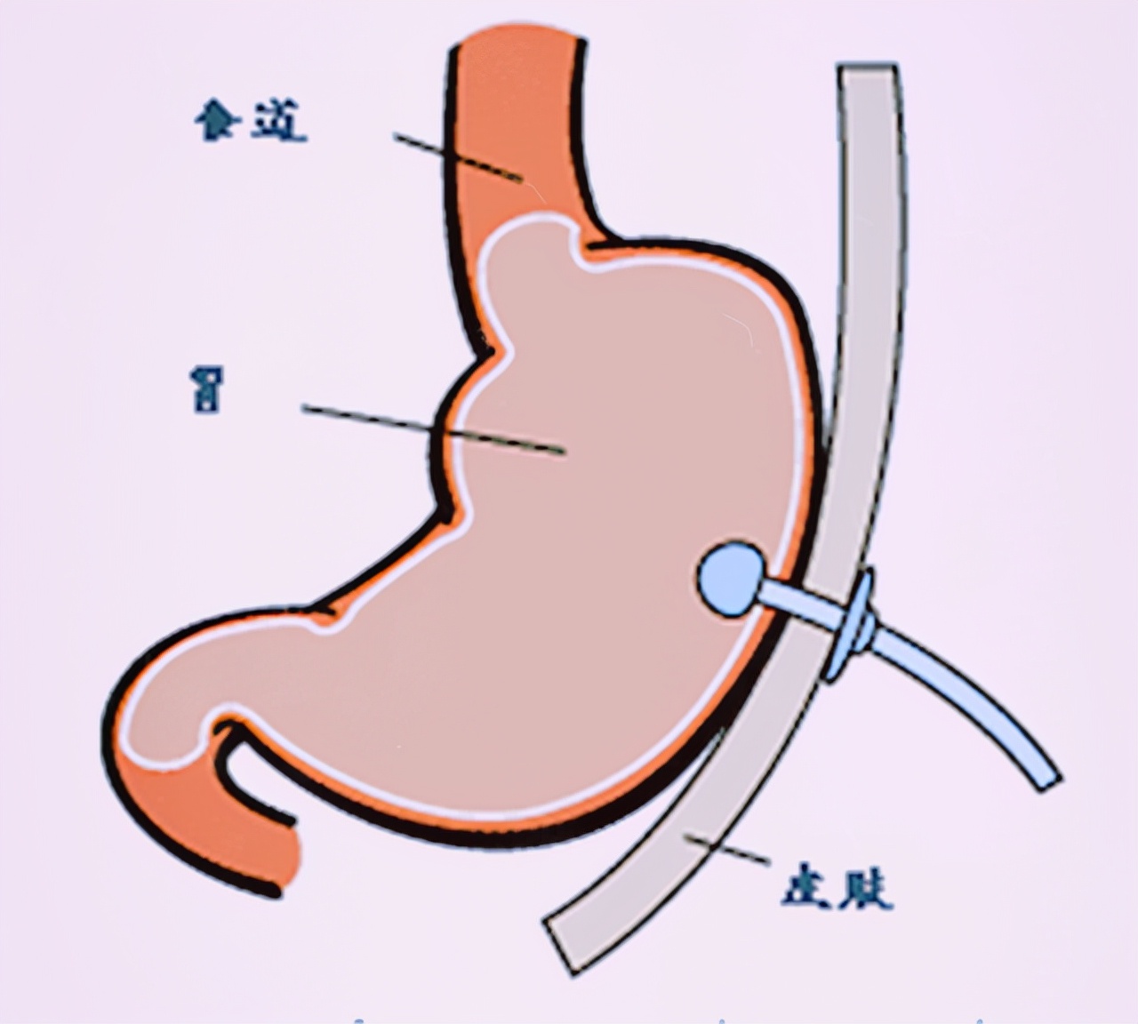 经皮内镜下胃造瘘术操作流程,经皮内镜下胃造瘘术并发症发生率