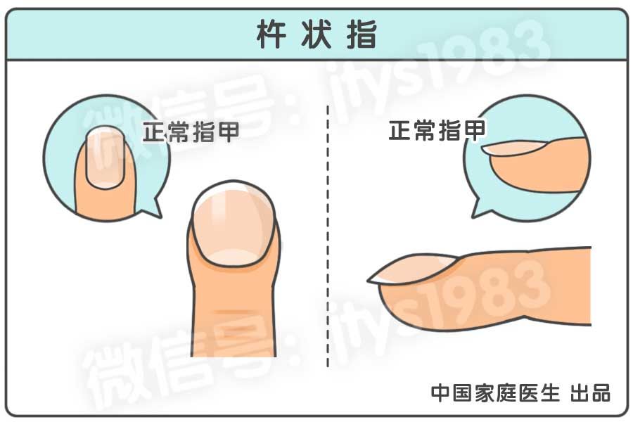 指甲上月牙少是什么问题,指甲月牙少了怎么回事