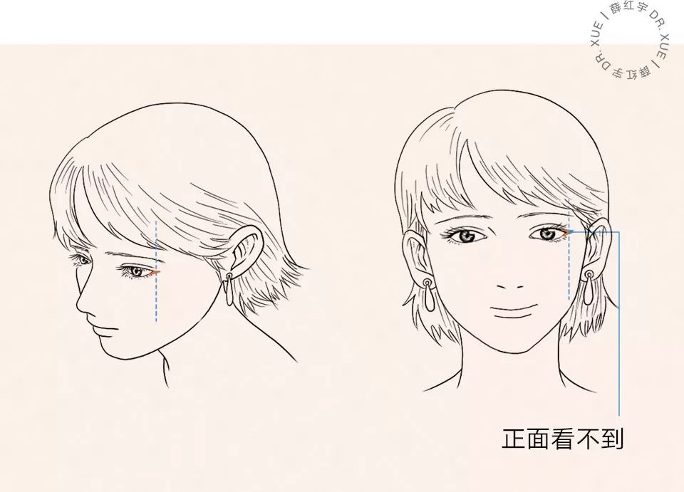 要不要开下眼睑,要不要开内眦赘皮