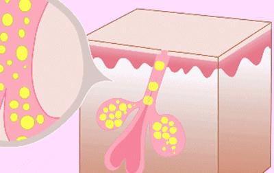 “毛孔粗大”粗的并不是“毛孔”,它是瘢痕呀！三种方法有效解决