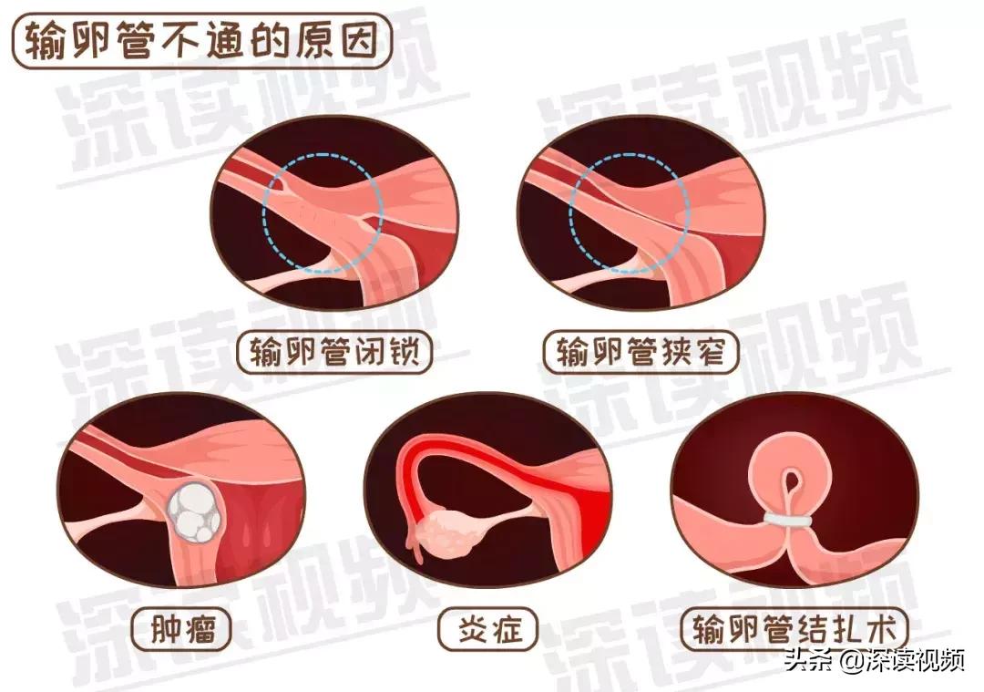 宫外孕和男性不良习惯有关系吗,这些习惯会导致不孕