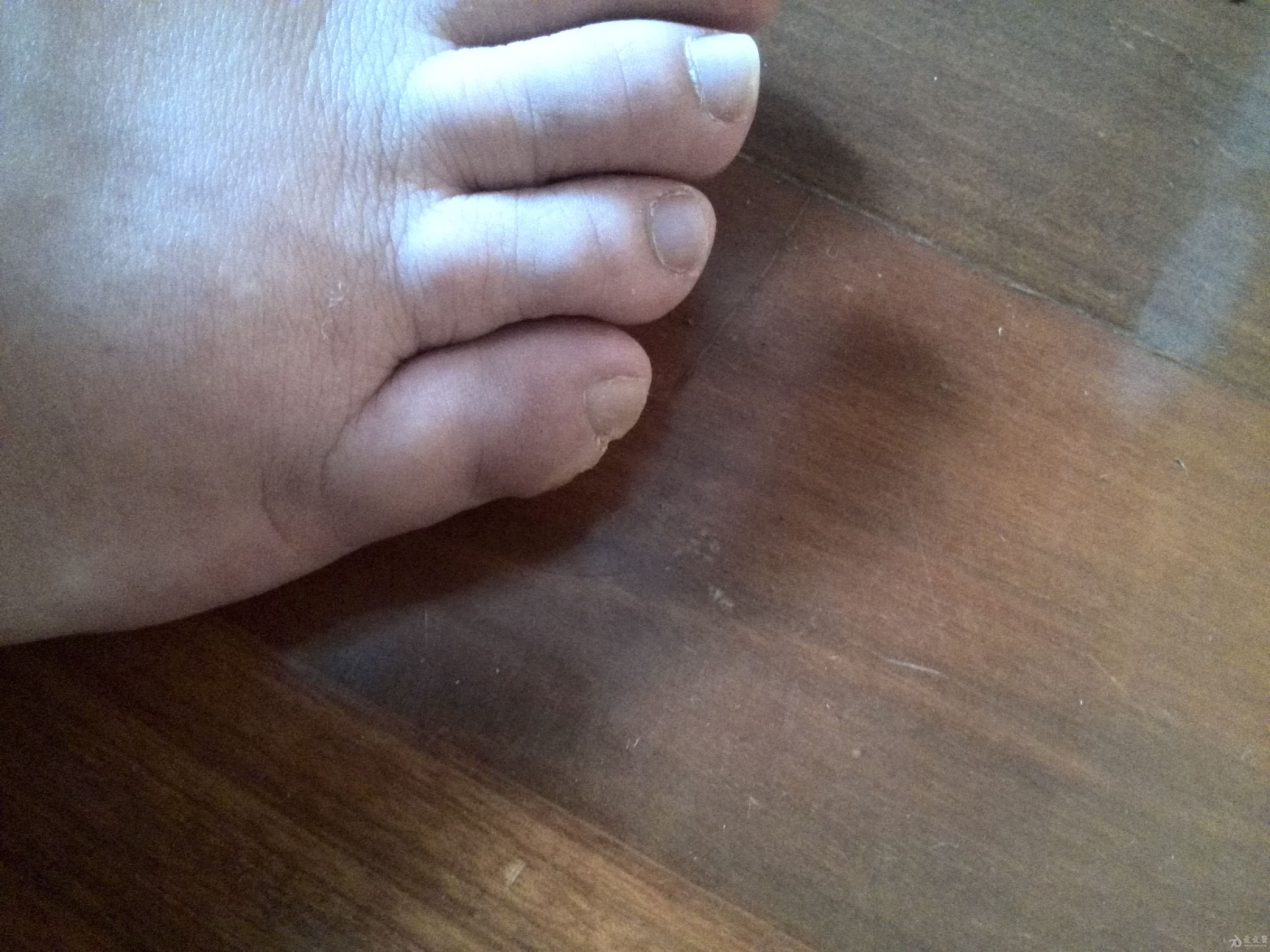 颈部上的小肉球如何处理,颈部突然长了个小疙瘩是怎么回事