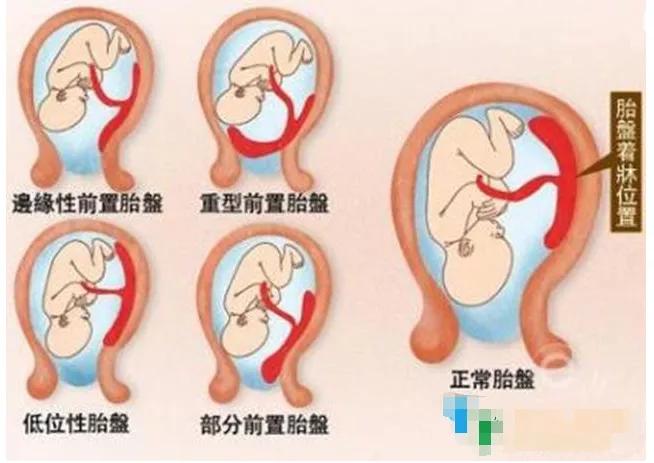 孕期发现胎盘前置是什么原因,引产前有什么症状