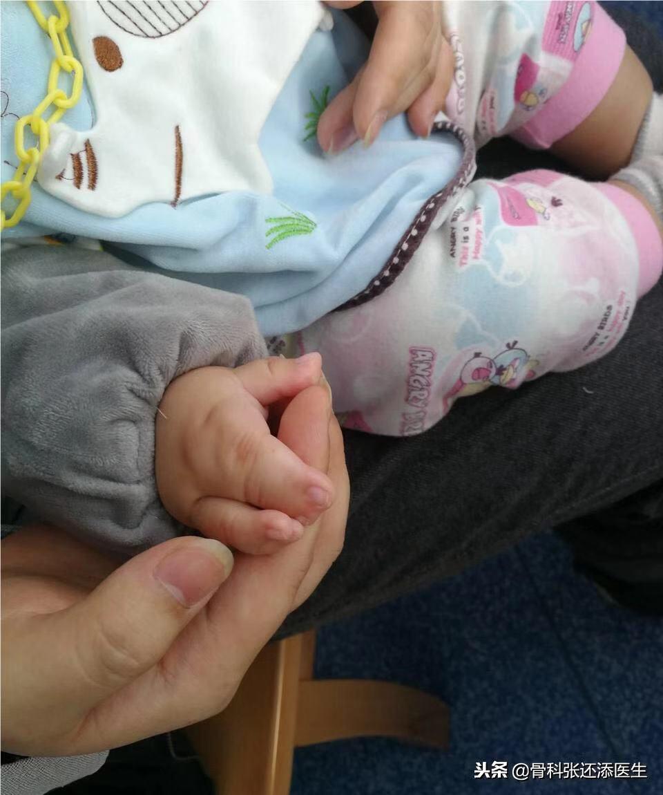 小朋友O型腿,X型腿,需要干预吗,怎么矫正?骨科医生告诉你