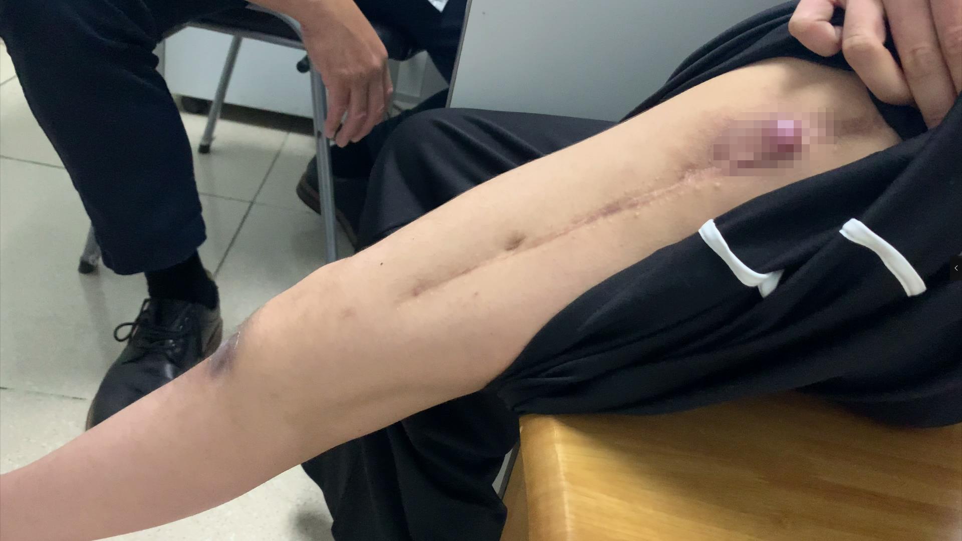 骨癌截肢后怎么恢复好,骨癌截肢后怎么办