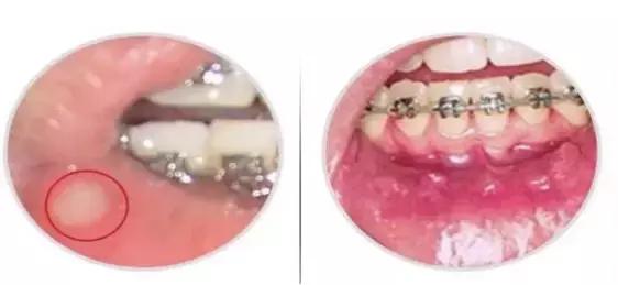 牙齿疼痛按摩哪里可以缓解,矫正牙齿打钢钉几天能缓解疼痛