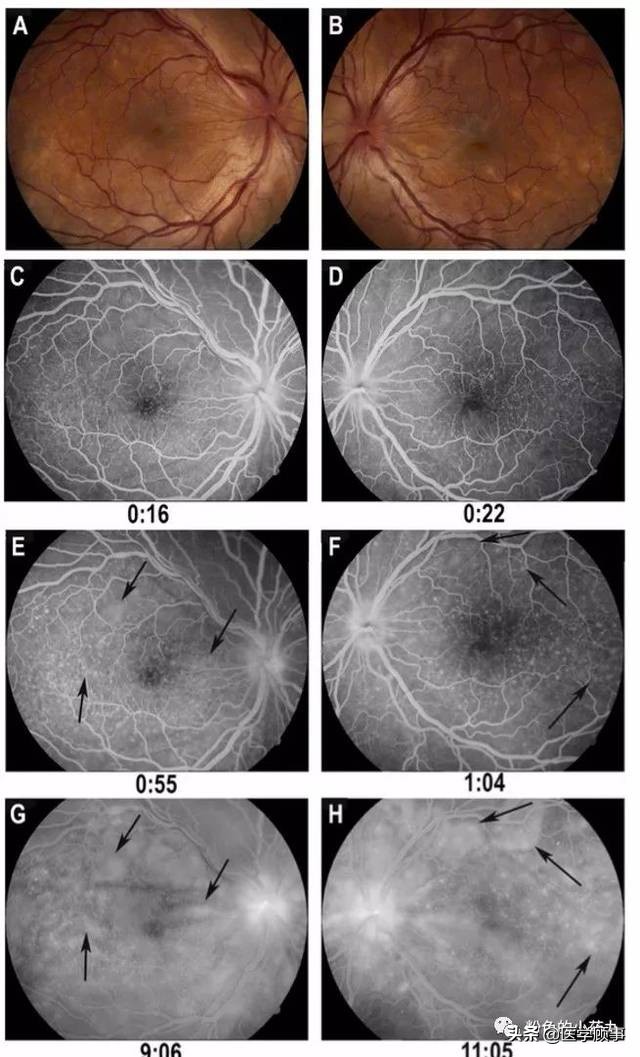 小柳原田综合征需要配眼镜吗,小柳原田综合征是罕见病吗