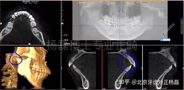 颞下颌关节紊乱精神紧张复发,颞下颌关节紊乱症能做牙齿矫正吗