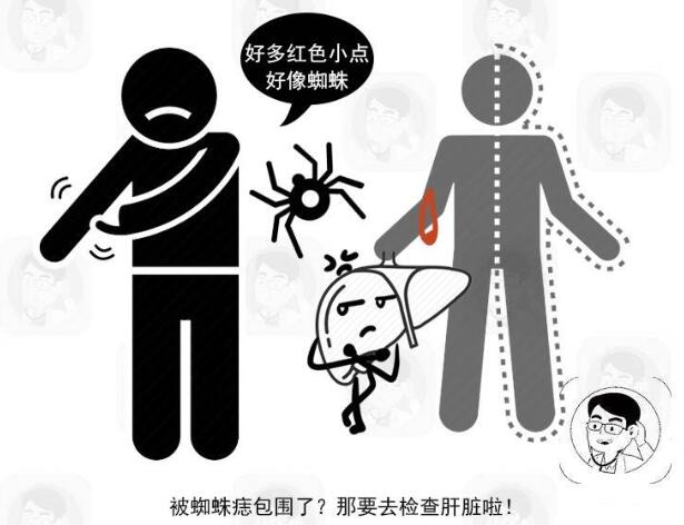 肝硬化蜘蛛痣什么情况会出现,出现蜘蛛痣了肝硬化到什么程度