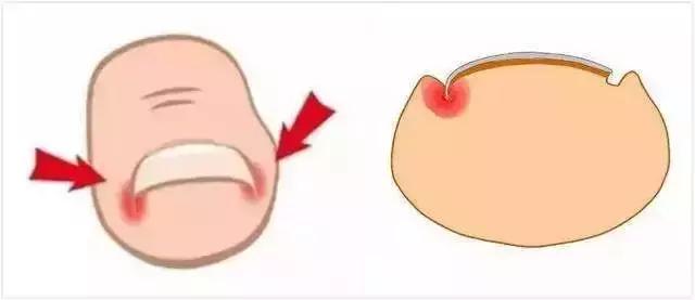 治疗甲沟炎真正有效的办法,甲沟炎指甲剪神器正品