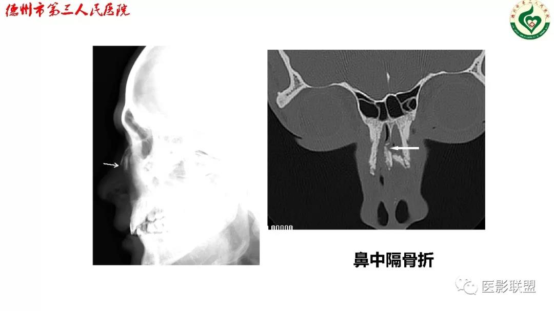 鼻骨骨折影像,鼻骨骨折dr影像表现