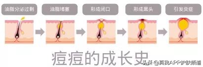 脸上长痘痘反反复复该怎么办,脸上一个部位反反复复长痘痘