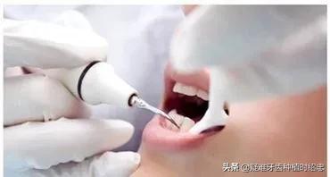 比较严重的牙周炎,时不时会流牙血应该如何治疗？