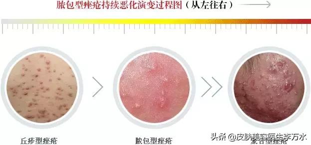 痘痘十大真相,痘痘大全图解