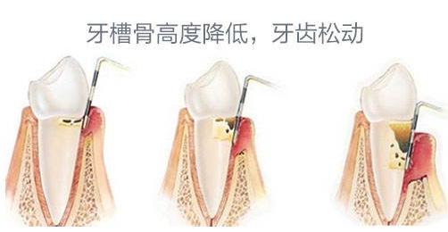 牙齿松动，难以避免的中年危机？慌了