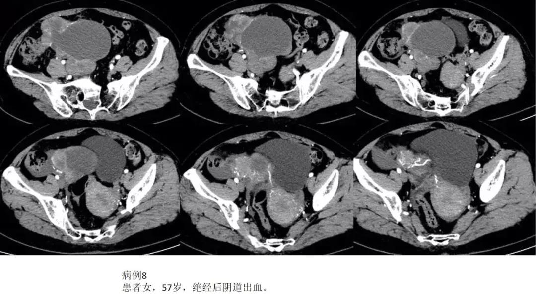 卵巢原发肿瘤的分析思路
