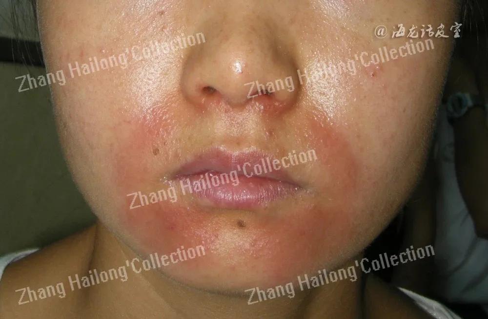 常见的脸部皮肤病有哪些,面部皮肤病辨别图解