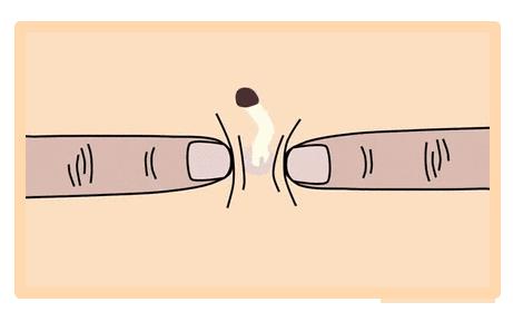 为什么你的黑头总是反复,为什么有些黑头自己能长出来