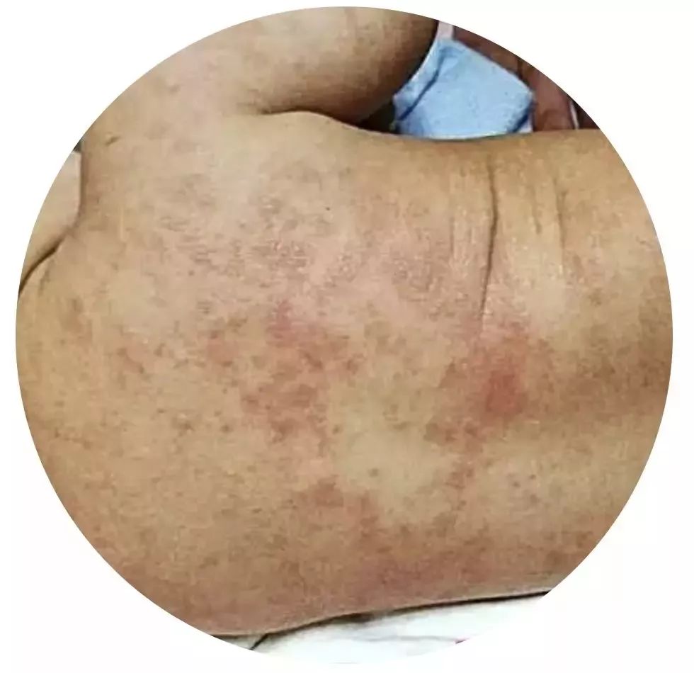 夏天宝宝长痱子怎么办,宝宝夏季长痱子怎么办