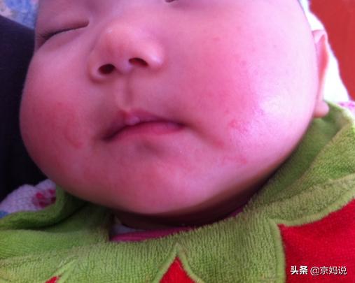 婴幼儿长牙的时候流口水疹,宝宝长牙流口水下巴都红了怎么办