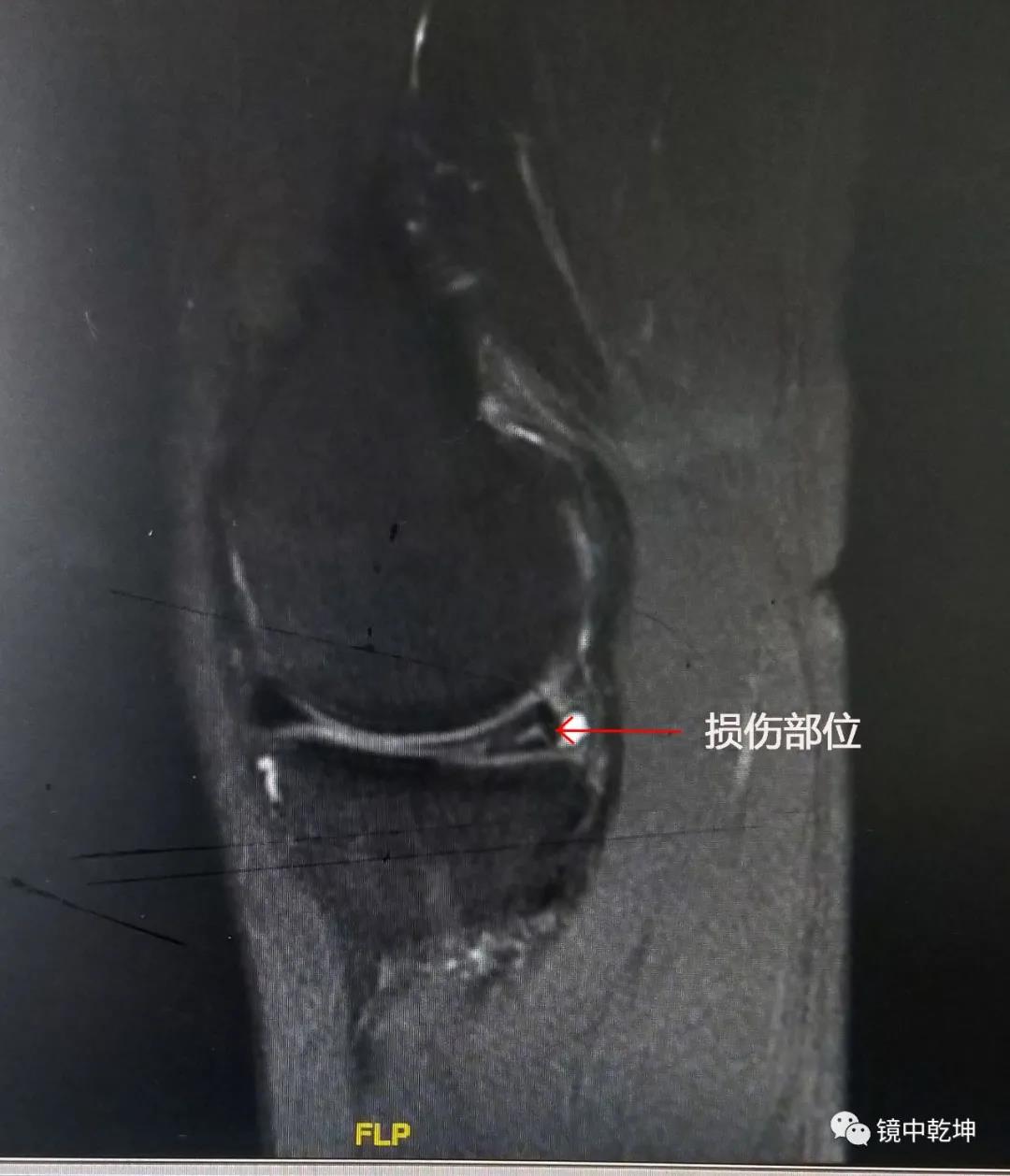 南大二附院系列科普：关节镜手术治疗膝关节半月板损伤