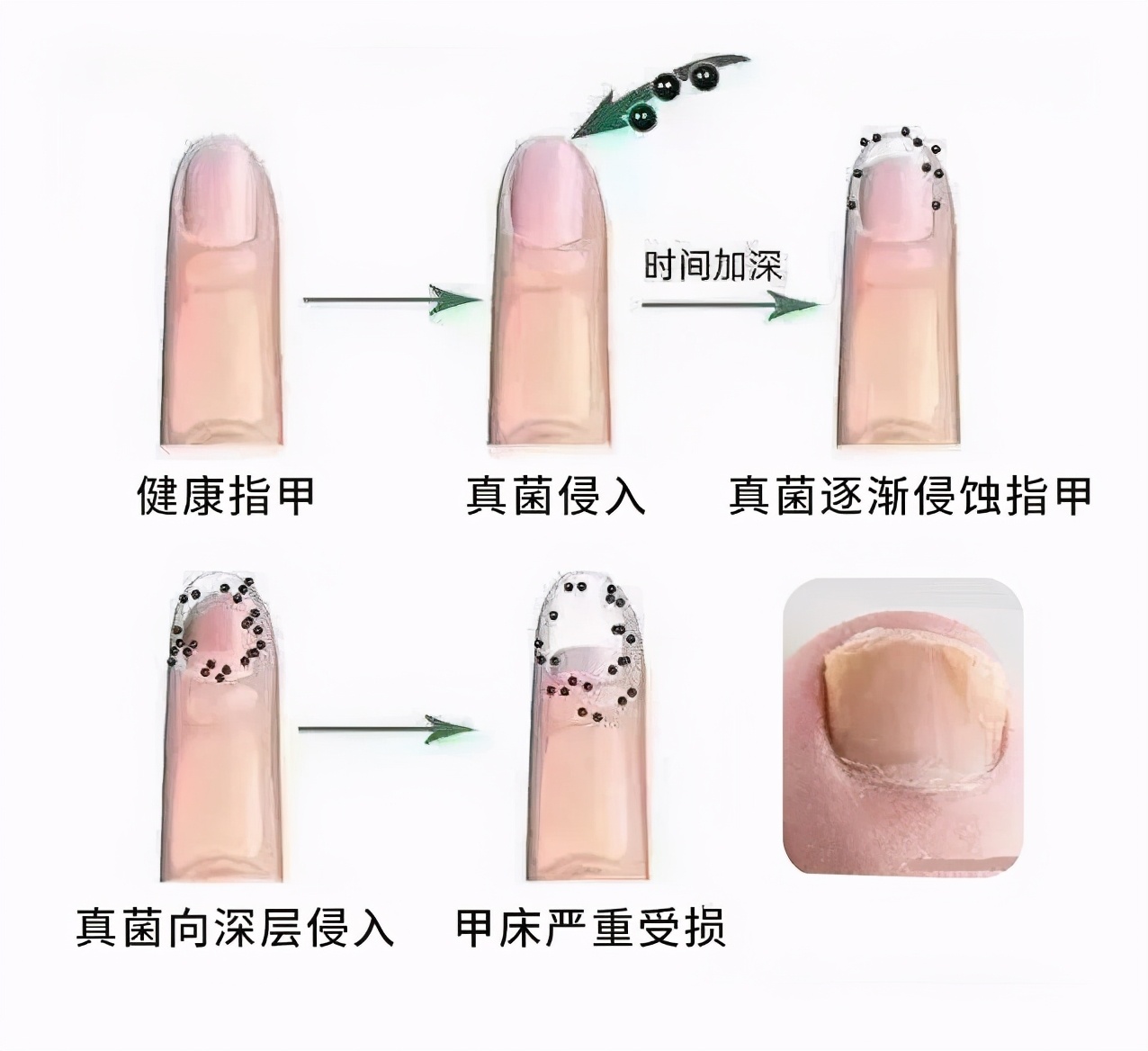 得了灰指甲如何避免传染,灰指甲一个传染俩下一句是什么