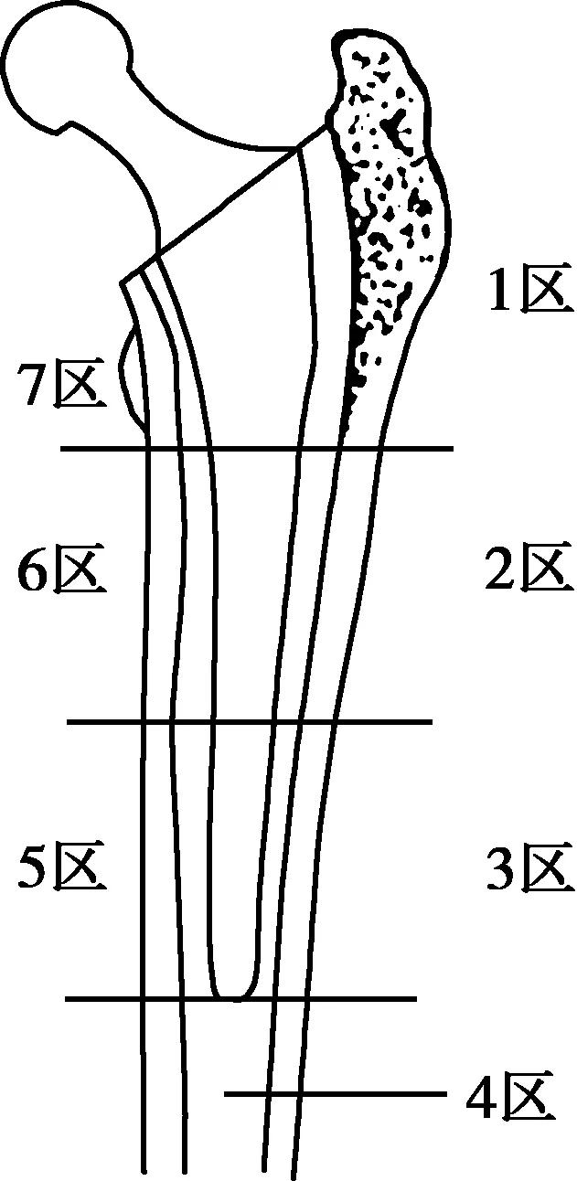 髋关节翻修术手术流程,人工髋关节翻修材料的选择