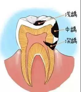 牙齿补牙几年后疼不能重新补牙吗,补牙前不疼补牙后咬东西牙疼