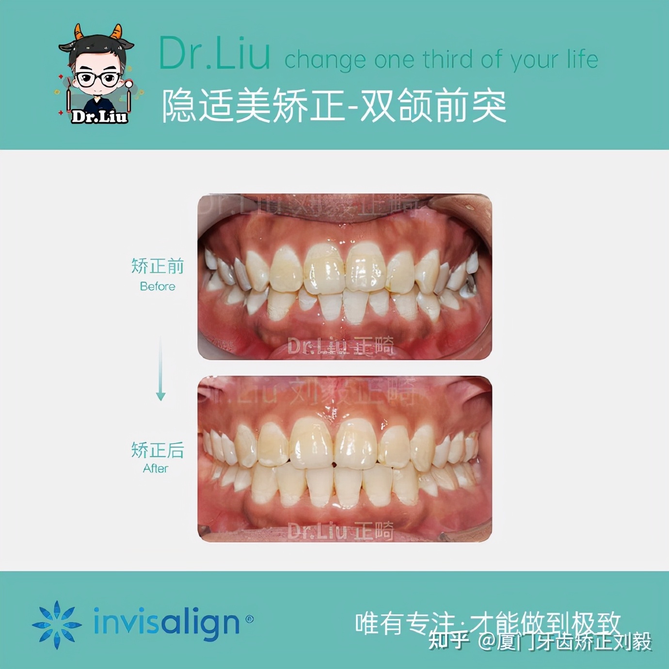 下嘴唇厚且外翻牙齿矫正,深覆合牙齿矫正嘴凸