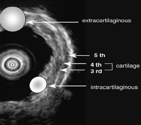 全球对肺癌治疗的最有效最新技术,肺癌的支气管镜介入治疗