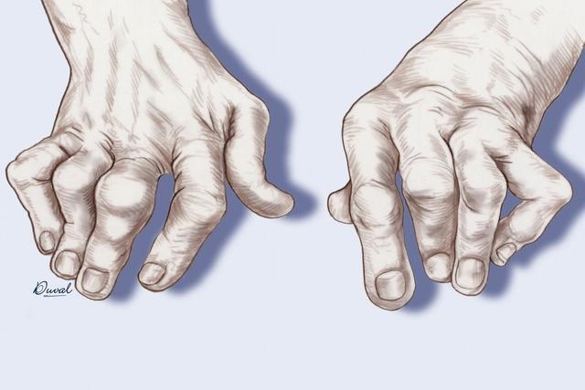 手部出现3种异样可能患癌,手出现问题是什么病前兆