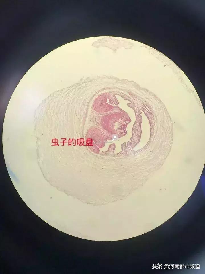 30岁女一边头皮发麻,一女子头皮里有虫子