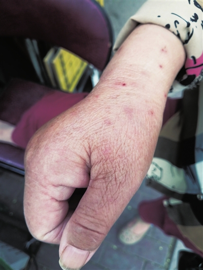 银川德胜一区多位居民遇咄咄怪事：身上起红疹，奇痒无比